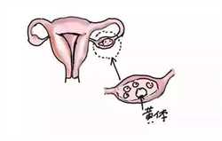 女性子宫腺肌症患病原因有哪些？
